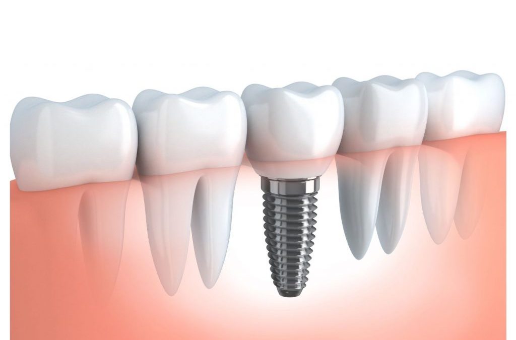 Implantes dentales Madrid